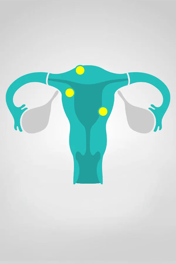 Charlotte-Fibroids-Treatment Charlotte Fibroids Treatment