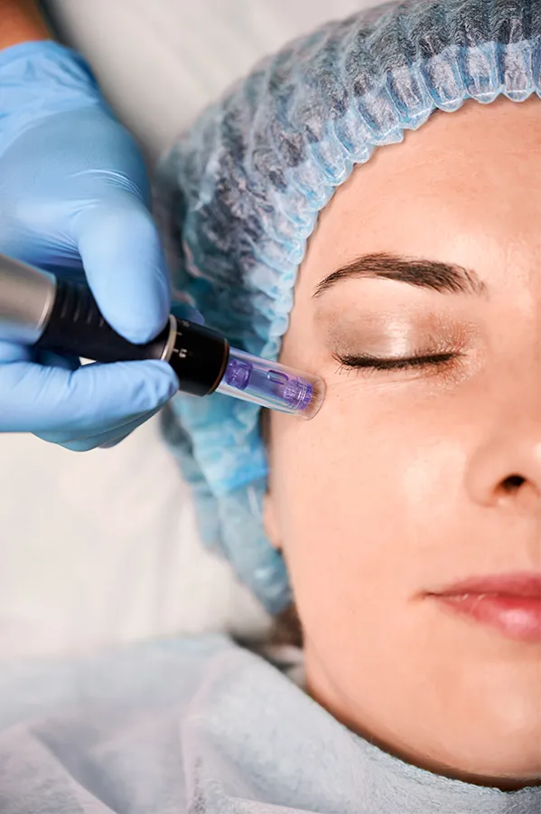 Charlotte-Microneedling-Treatment Charlotte Microneedling Treatment