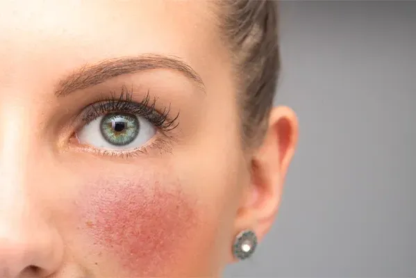Charlotte-Rosacea-Doctor Charlotte Rosacea Doctor