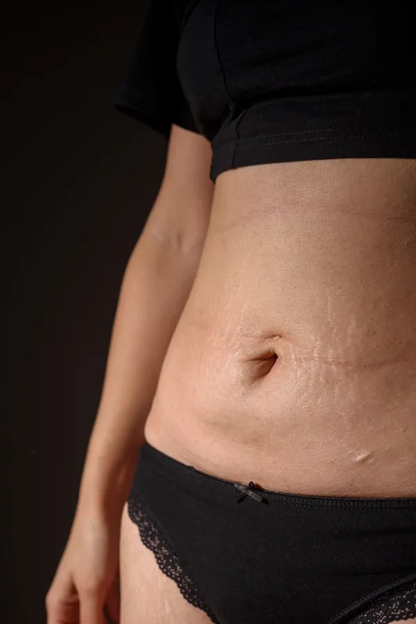 Charlotte-Stretch-Marks-Treatment Charlotte Stretch Marks Treatment