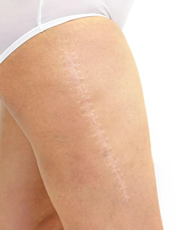 Charlotte-Surgical-Scars-Treatment Charlotte Surgical Scars Treatment